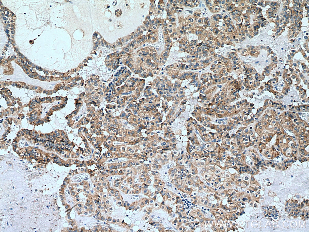 Immunohistochemistry (IHC) staining of human thyroid cancer tissue using calreticulin Recombinant antibody (80017-1-RR)