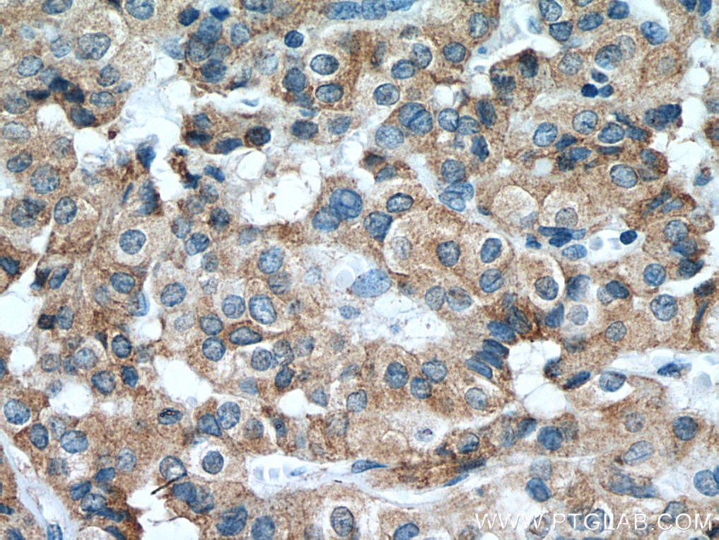 Immunohistochemistry (IHC) staining of human thyroid cancer tissue using calreticulin Recombinant antibody (80017-1-RR)