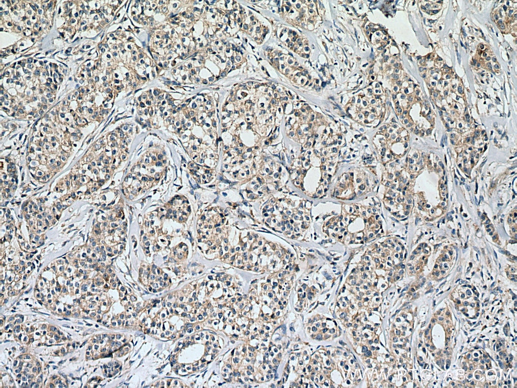 Immunohistochemistry (IHC) staining of human breast cancer tissue using calreticulin Recombinant antibody (80017-1-RR)