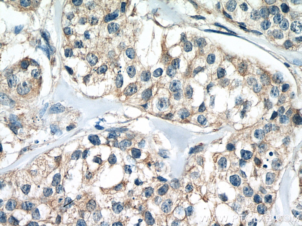 Immunohistochemistry (IHC) staining of human breast cancer tissue using calreticulin Recombinant antibody (80017-1-RR)