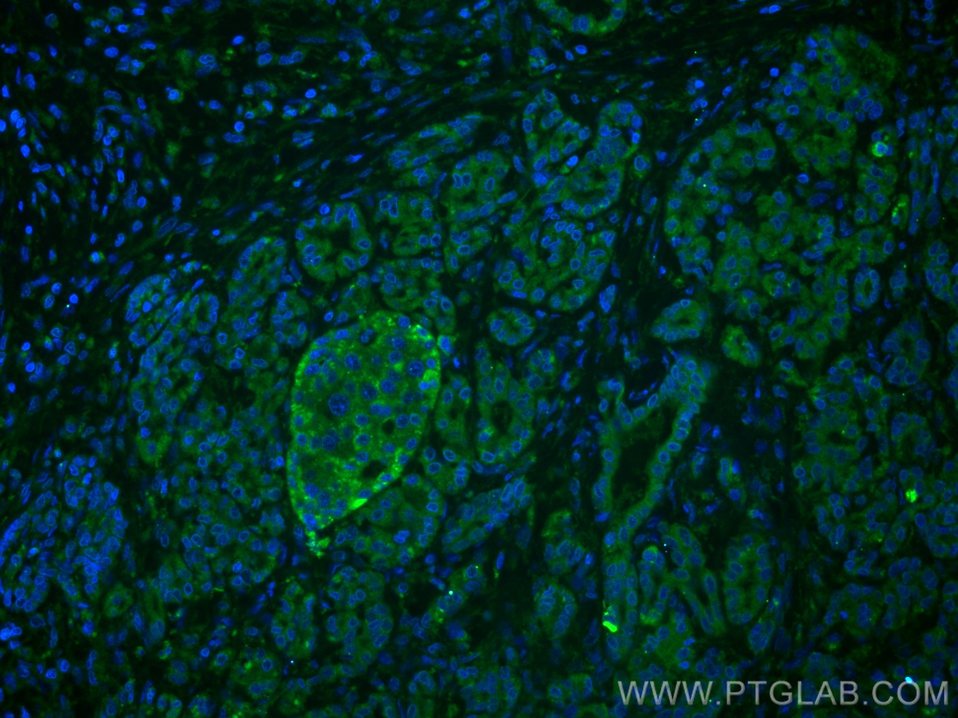 Immunofluorescence (IF) / fluorescent staining of human pancreas cancer tissue using Chromogranin A Monoclonal antibody (60135-2-Ig)