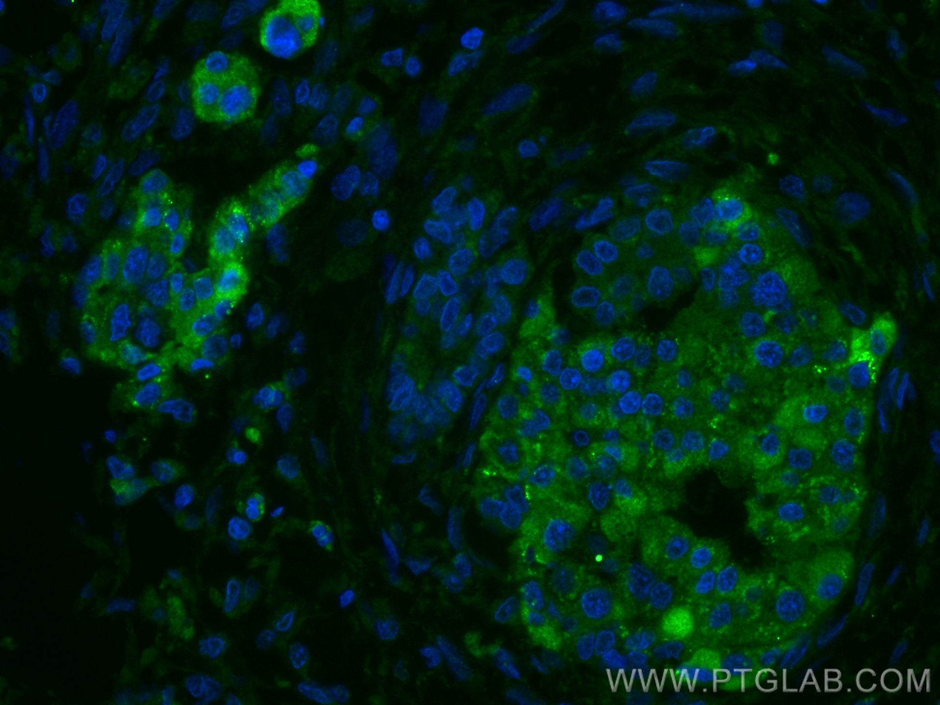 Immunofluorescence (IF) / fluorescent staining of human pancreas cancer tissue using Chromogranin A Monoclonal antibody (60135-2-Ig)