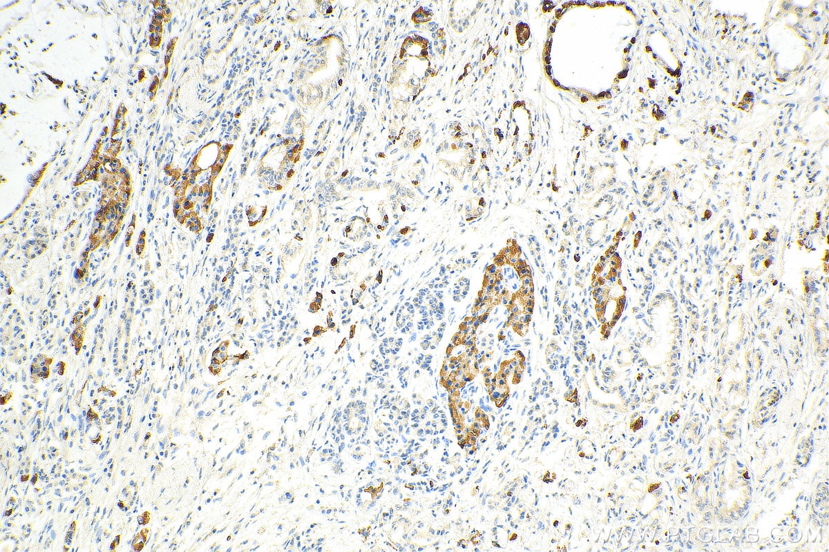 Immunohistochemistry (IHC) staining of human pancreas cancer tissue using Chromogranin A Monoclonal antibody (60135-2-Ig)
