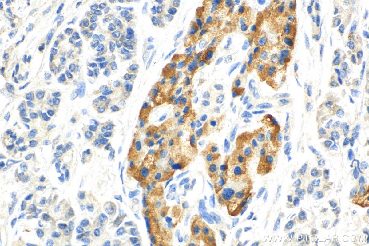 Immunohistochemistry (IHC) staining of human pancreas cancer tissue using Chromogranin A Monoclonal antibody (60135-2-Ig)