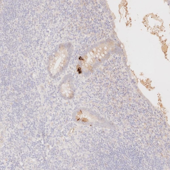 IHC staining of human appendicitis using 60135-2-Ig Immunohistochemistry (IHC) staining of human appendicitis tissue using Chromogranin A Monoclonal antibody (60135-2-Ig)