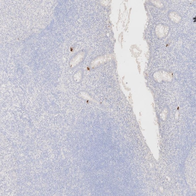 IHC staining of human appendicitis using 60135-2-Ig Immunohistochemistry (IHC) staining of human appendicitis tissue using Chromogranin A Monoclonal antibody (60135-2-Ig)