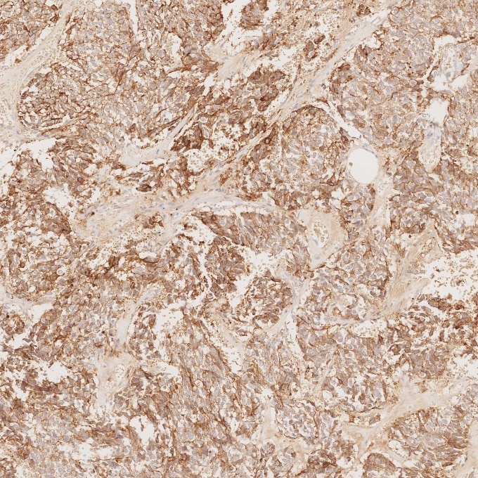 IHC staining of human pituitary adenoma using 60135-2-Ig Immunohistochemistry (IHC) staining of human pituitary adenoma tissue using Chromogranin A Monoclonal antibody (60135-2-Ig)