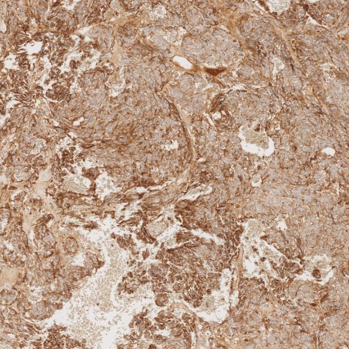 IHC staining of human pituitary adenoma using 60135-2-Ig Immunohistochemistry (IHC) staining of human pituitary adenoma tissue using Chromogranin A Monoclonal antibody (60135-2-Ig)
