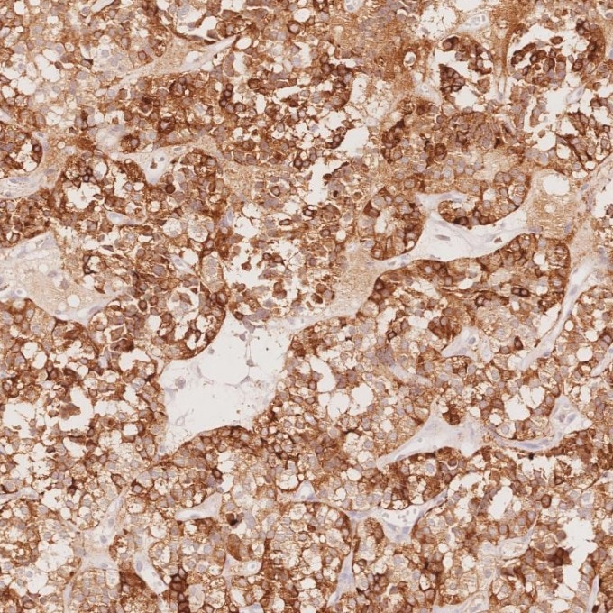 IHC staining of human pituitary adenoma using 60135-2-Ig Immunohistochemistry (IHC) staining of human pituitary adenoma tissue using Chromogranin A Monoclonal antibody (60135-2-Ig)