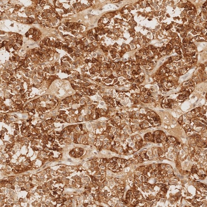 IHC staining of human pituitary adenoma using 60135-2-Ig Immunohistochemistry (IHC) staining of human pituitary adenoma tissue using Chromogranin A Monoclonal antibody (60135-2-Ig)