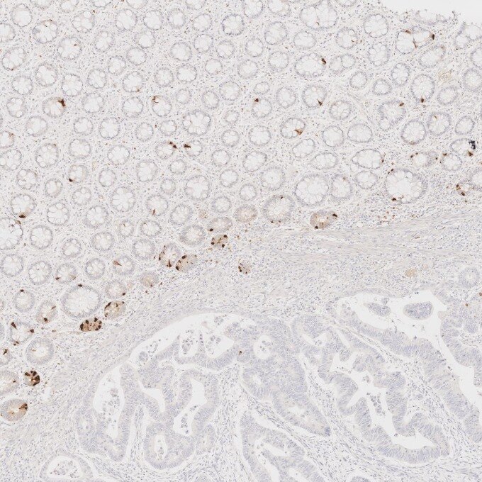 IHC staining of human colorectal cancer using 60135-2-Ig Immunohistochemistry (IHC) staining of human colorectal cancer tissue using Chromogranin A Monoclonal antibody (60135-2-Ig)