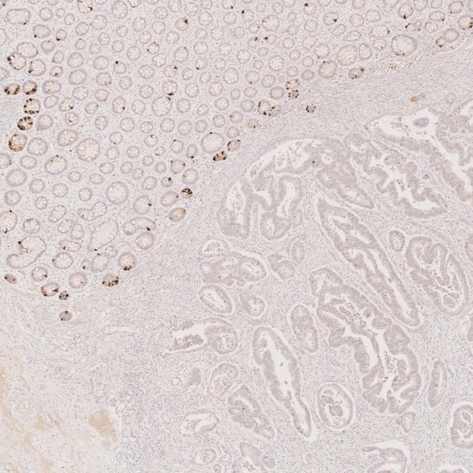 IHC staining of human colorectal cancer using 60135-2-Ig Immunohistochemistry (IHC) staining of human colorectal cancer tissue using Chromogranin A Monoclonal antibody (60135-2-Ig)