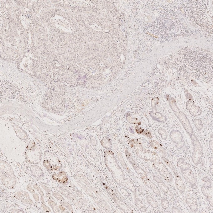 IHC staining of human stomach cancer using 60135-2-Ig Immunohistochemistry (IHC) staining of human stomach cancer tissue using Chromogranin A Monoclonal antibody (60135-2-Ig)