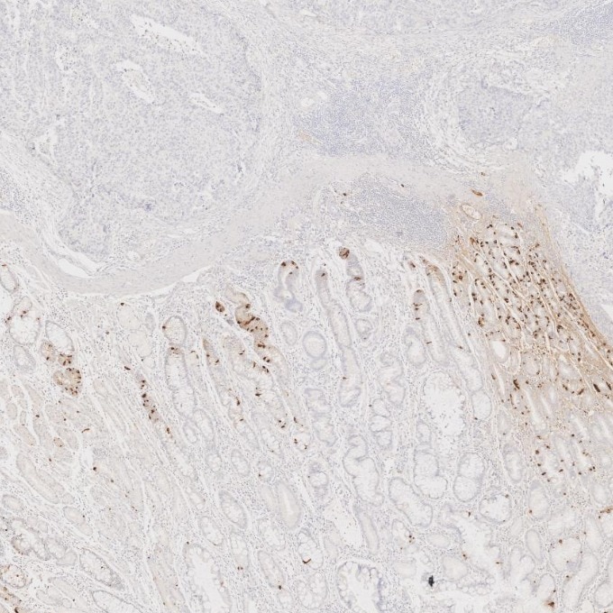 IHC staining of human stomach cancer using 60135-2-Ig Immunohistochemistry (IHC) staining of human stomach cancer tissue using Chromogranin A Monoclonal antibody (60135-2-Ig)