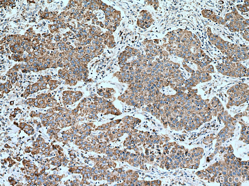 Immunohistochemistry (IHC) staining of human breast cancer tissue using citrate synthase Monoclonal antibody (67784-1-Ig)