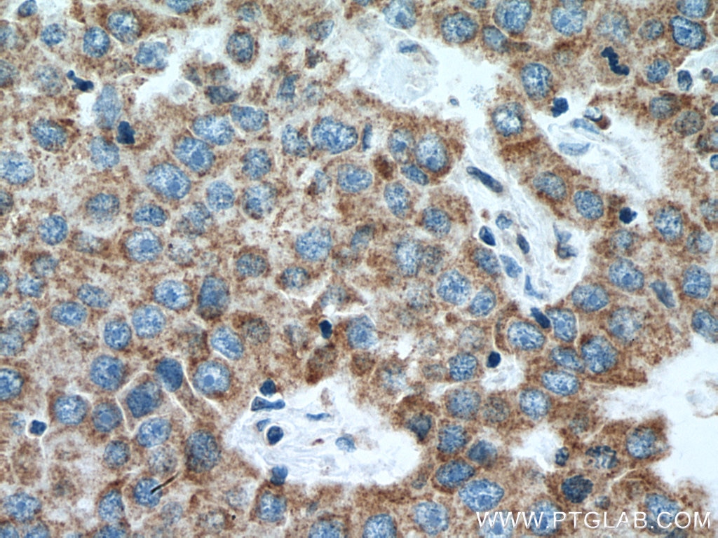 Immunohistochemistry (IHC) staining of human breast cancer tissue using citrate synthase Monoclonal antibody (67784-1-Ig)