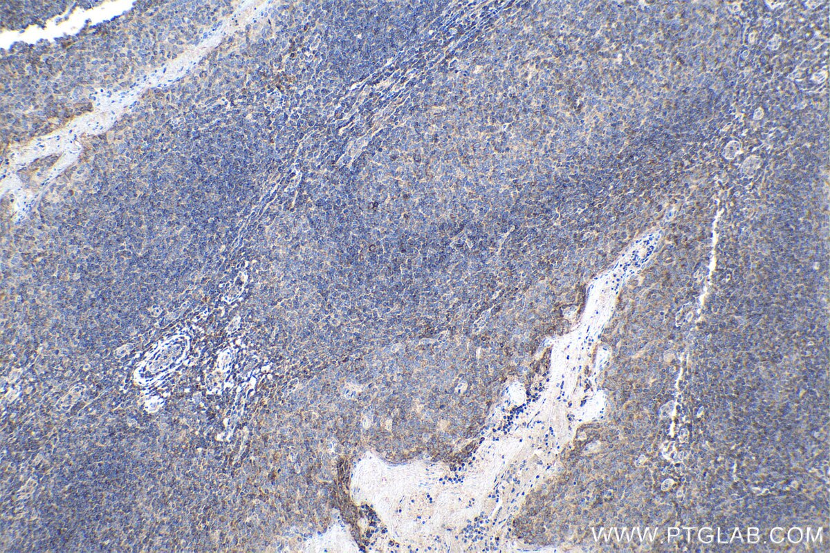 IHC staining of human tonsillitis using 67686-1-Ig