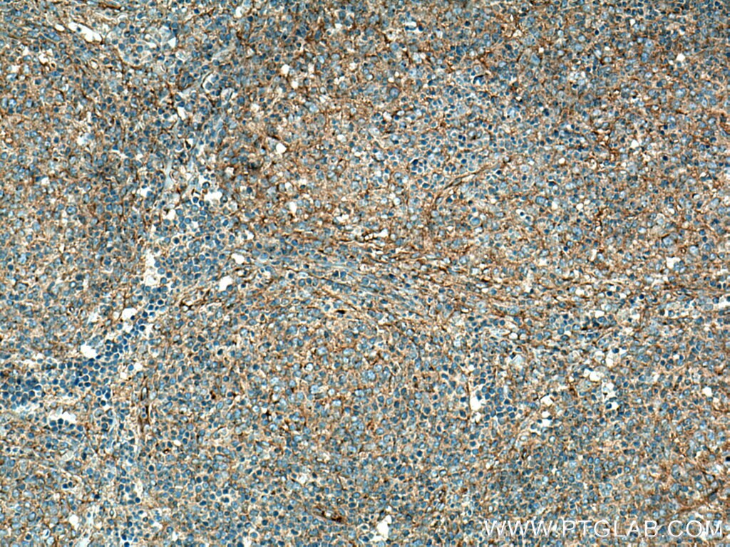 Immunohistochemistry (IHC) staining of human lymphoma tissue using Dynamitin (69-376 AA) Polyclonal antibody (10030-2-AP)