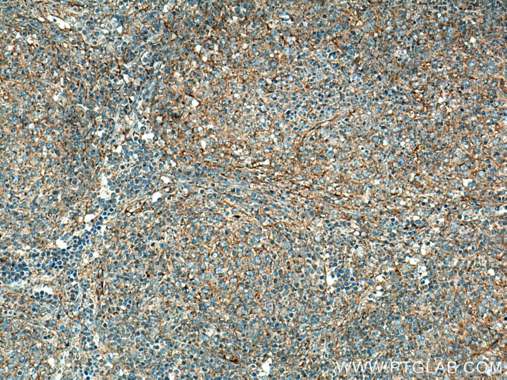 Immunohistochemistry (IHC) staining of human lymphoma tissue using Dynamitin (69-376 AA) Polyclonal antibody (10030-2-AP)