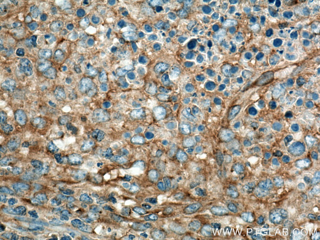 IHC staining of human lymphoma using 10030-2-AP