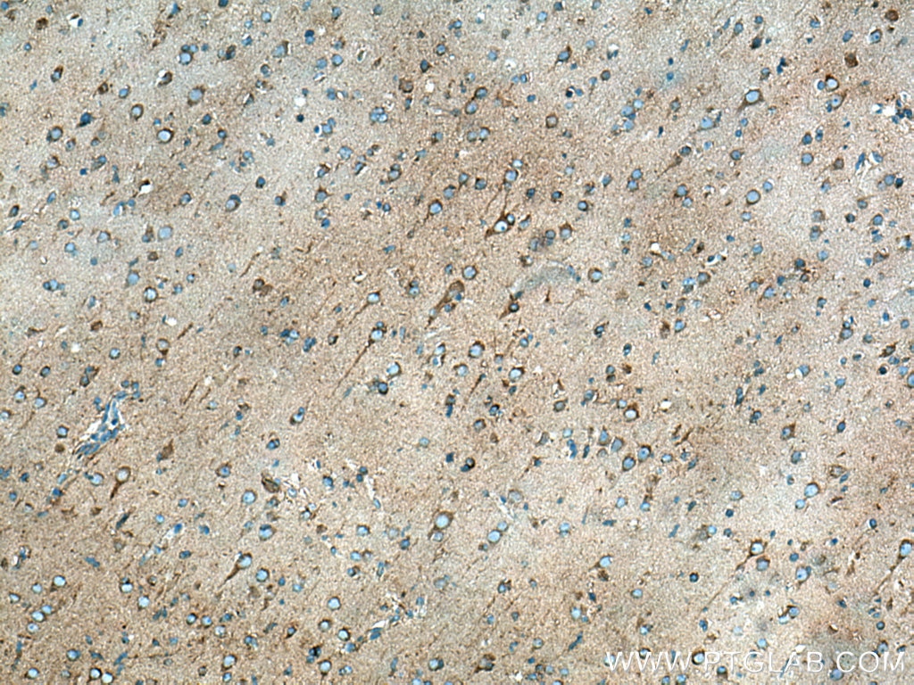 Immunohistochemistry (IHC) staining of human gliomas tissue using Dynamitin (69-376 AA) Polyclonal antibody (10030-2-AP)