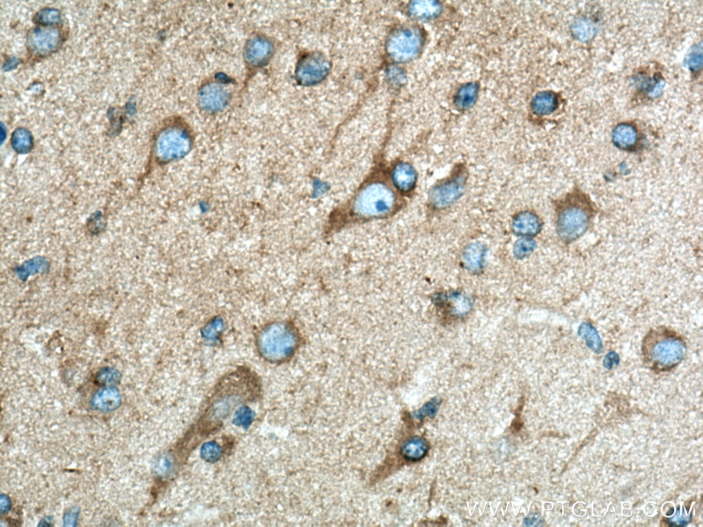 Immunohistochemistry (IHC) staining of human gliomas tissue using Dynamitin (69-376 AA) Polyclonal antibody (10030-2-AP)