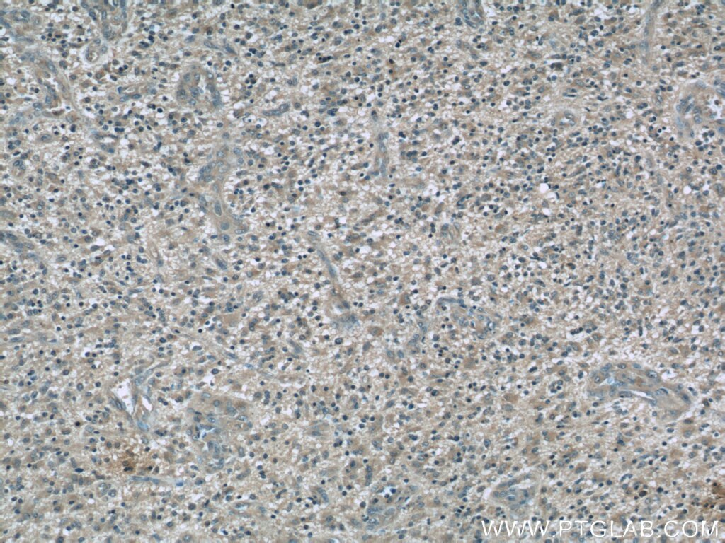 Immunohistochemistry (IHC) staining of human gliomas tissue using Dynamitin (1-401 AA) Monoclonal antibody (60257-1-Ig)