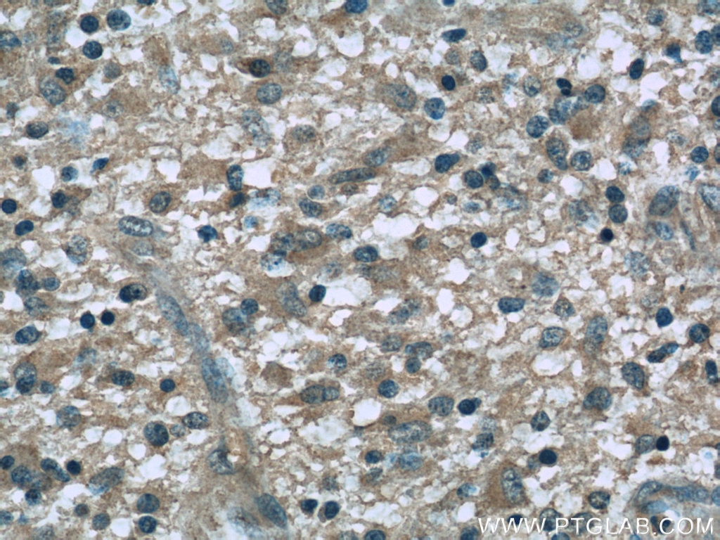 Immunohistochemistry (IHC) staining of human gliomas tissue using Dynamitin (1-401 AA) Monoclonal antibody (60257-1-Ig)