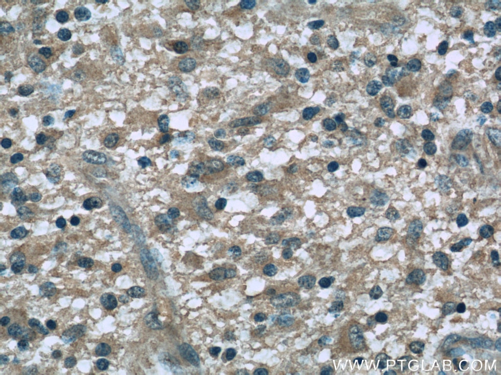 IHC staining of human gliomas using 60257-1-Ig