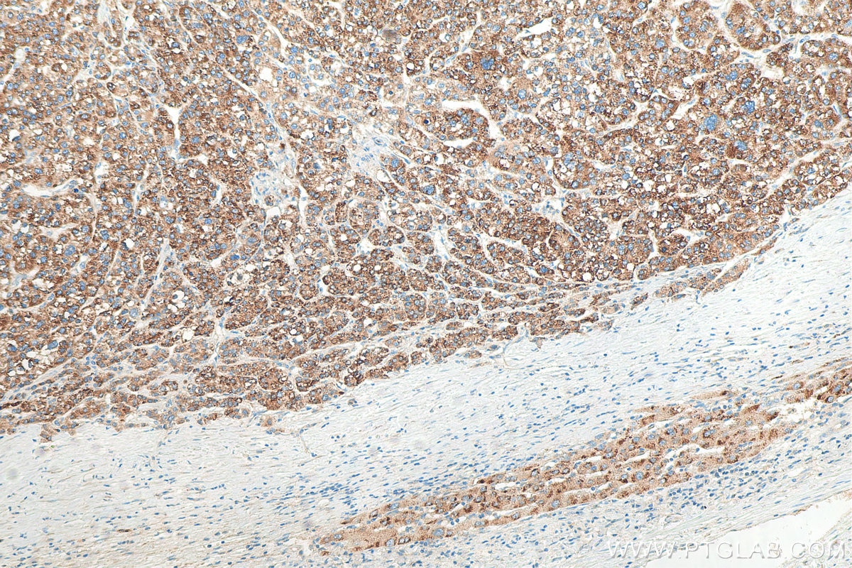 Immunohistochemistry (IHC) staining of human liver cancer tissue using fetuin-B Polyclonal antibody (18052-1-AP)