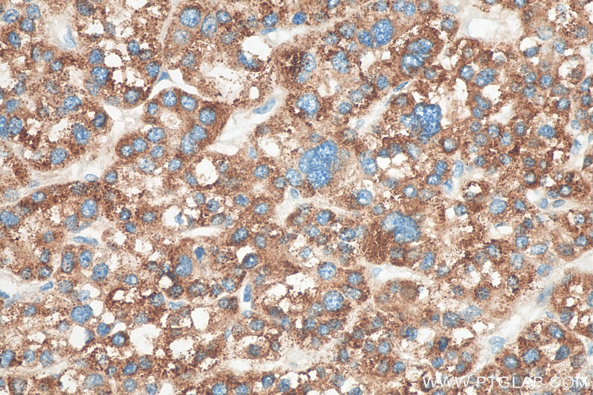 Immunohistochemistry (IHC) staining of human liver cancer tissue using fetuin-B Polyclonal antibody (18052-1-AP)