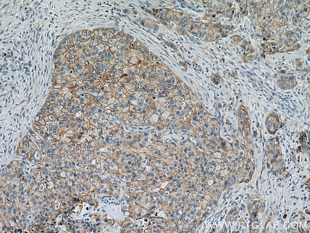 Immunohistochemistry (IHC) staining of human breast cancer tissue using Gamma Catenin Polyclonal antibody (27872-1-AP)