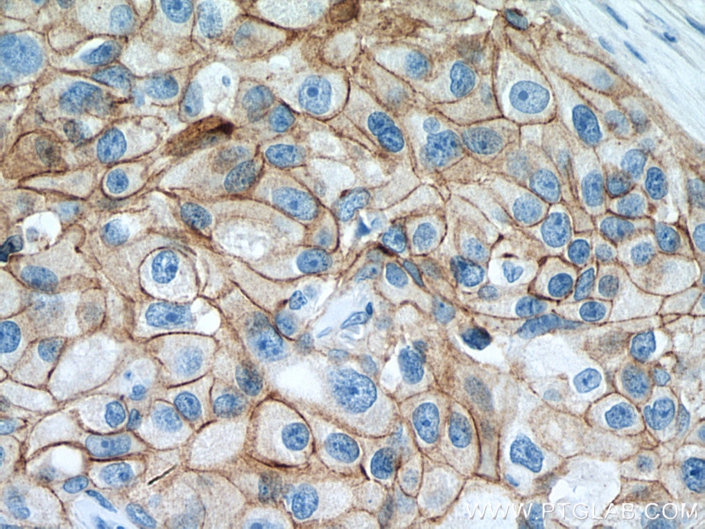 Immunohistochemistry (IHC) staining of human breast cancer tissue using Gamma Catenin Polyclonal antibody (27872-1-AP)