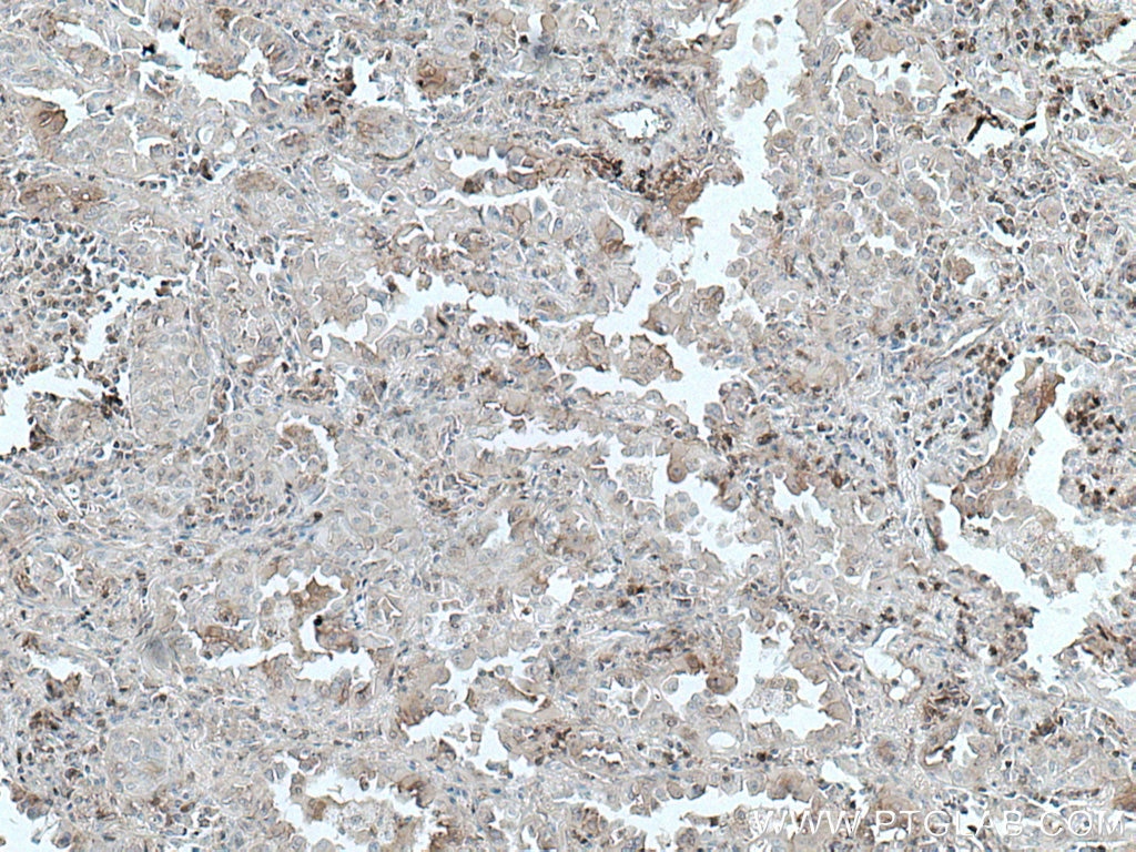 Immunohistochemistry (IHC) staining of human lung cancer tissue using hIST1 Monoclonal antibody (66989-1-Ig)