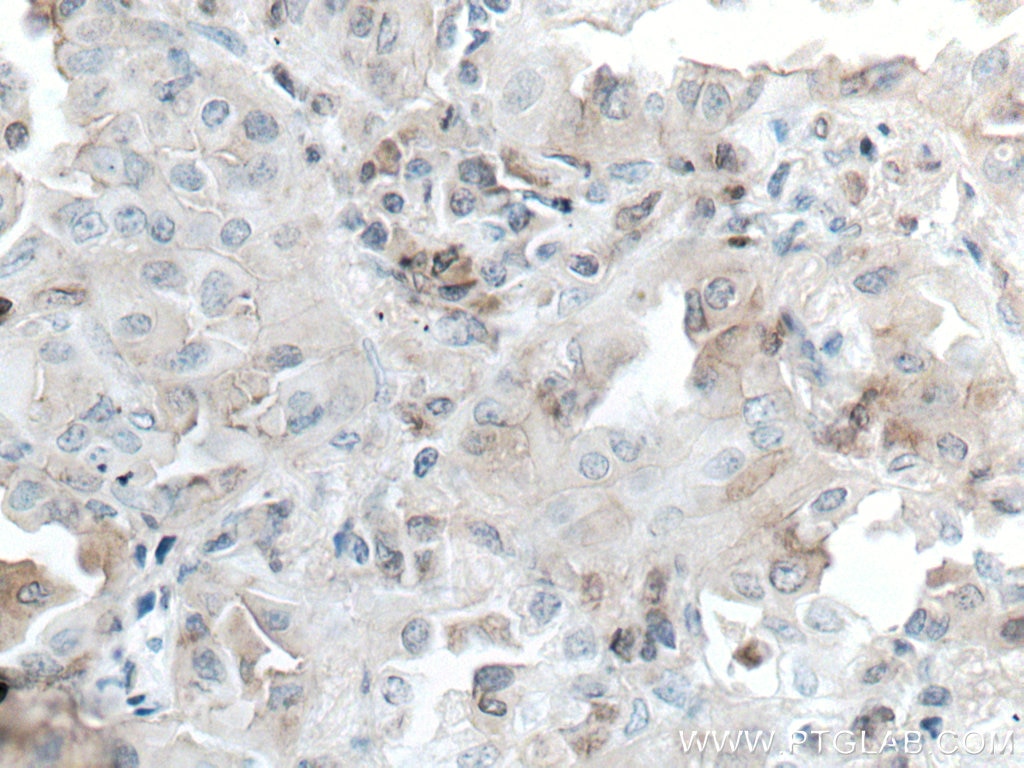 Immunohistochemistry (IHC) staining of human lung cancer tissue using hIST1 Monoclonal antibody (66989-1-Ig)