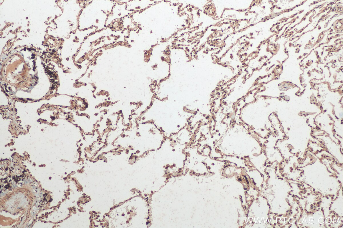 Immunohistochemistry (IHC) staining of human lung cancer tissue using hnRNP-E1 Polyclonal antibody (14523-1-AP)