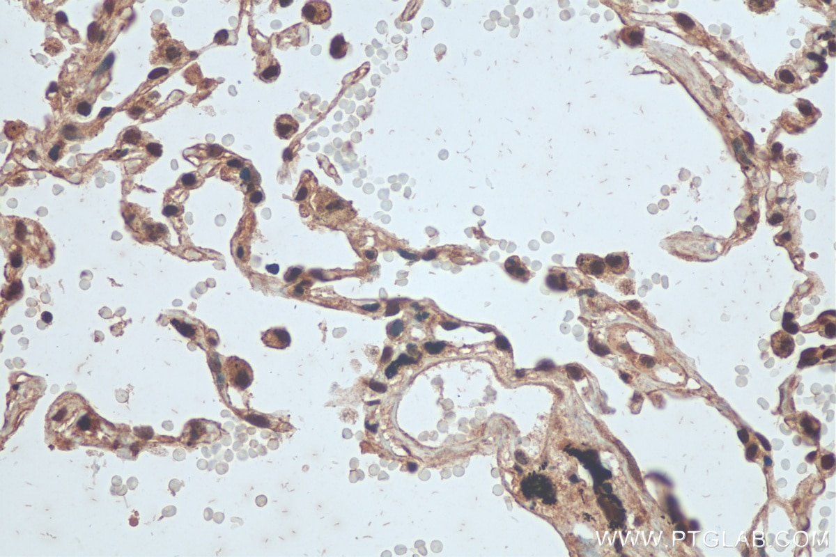 Immunohistochemistry (IHC) staining of human lung cancer tissue using hnRNP-E1 Polyclonal antibody (14523-1-AP)