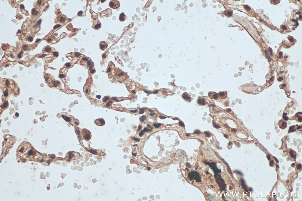 Immunohistochemistry (IHC) staining of human lung cancer tissue using hnRNP-E1 Polyclonal antibody (14523-1-AP)