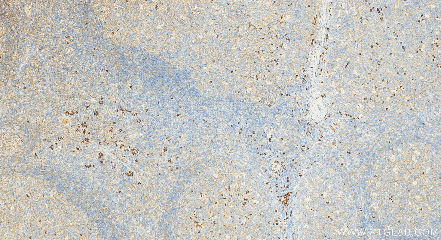 Immunohistochemistry (IHC) staining of human tonsillitis tissue using human IgG3 Polyclonal antibody (31495-1-AP)