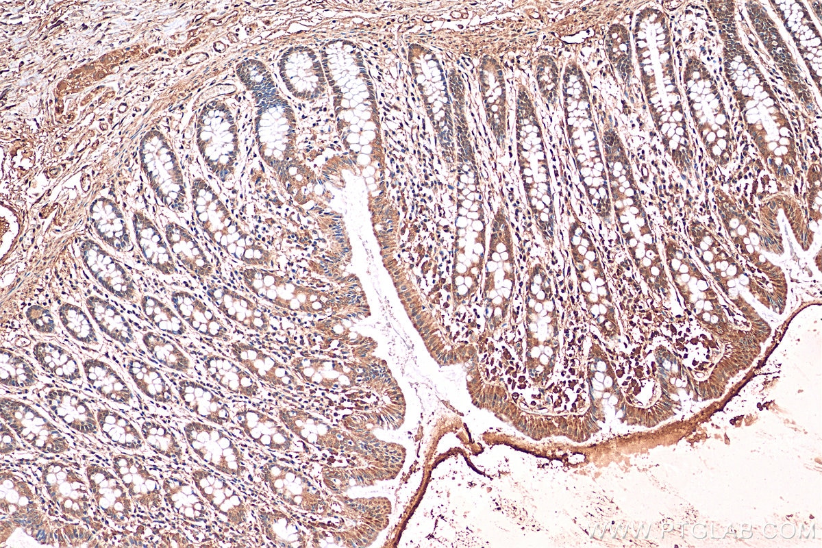 Immunohistochemistry (IHC) staining of human colon tissue using iNOS Recombinant antibody (80517-1-RR)