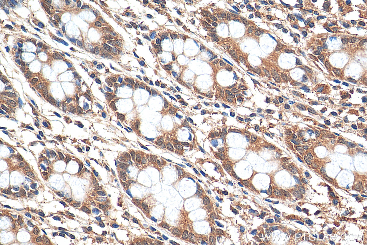 Immunohistochemistry (IHC) staining of human colon tissue using iNOS Recombinant antibody (80517-1-RR)