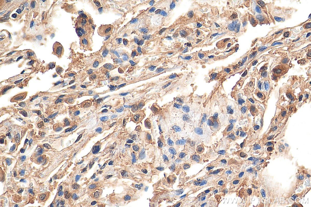 Immunohistochemistry (IHC) staining of human lung tissue using iNOS Recombinant antibody (80517-1-RR)