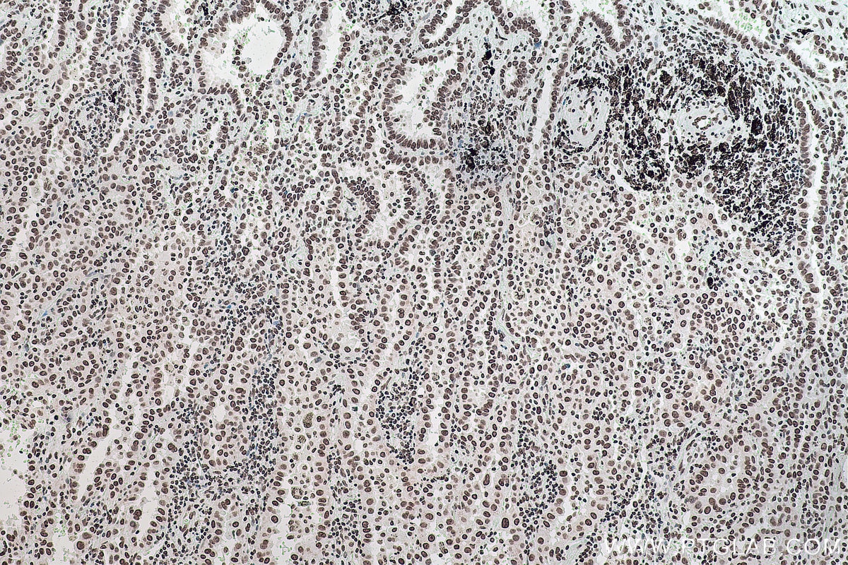 Immunohistochemistry (IHC) staining of human lung cancer tissue using m6A Monoclonal antibody (68055-1-Ig)