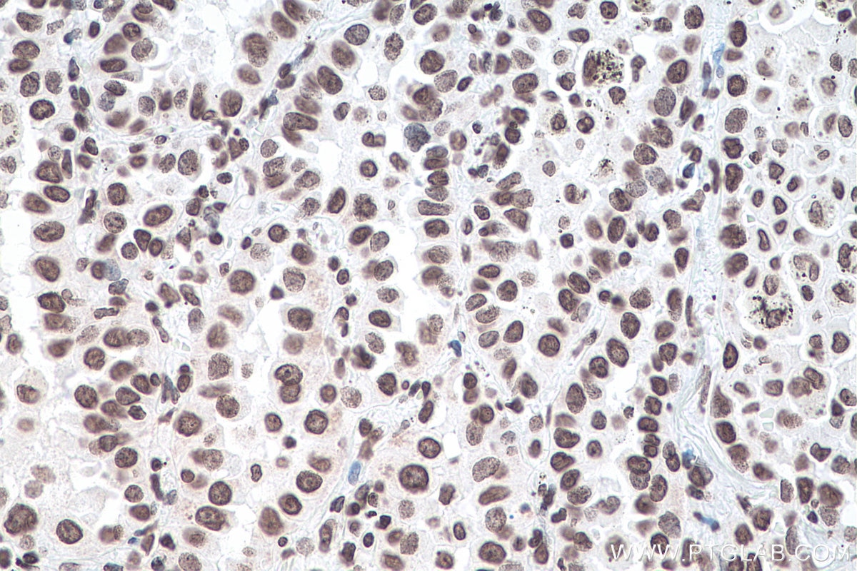 Immunohistochemistry (IHC) staining of human lung cancer tissue using chemical compound m6A Monoclonal antibody (68055-1-Ig)