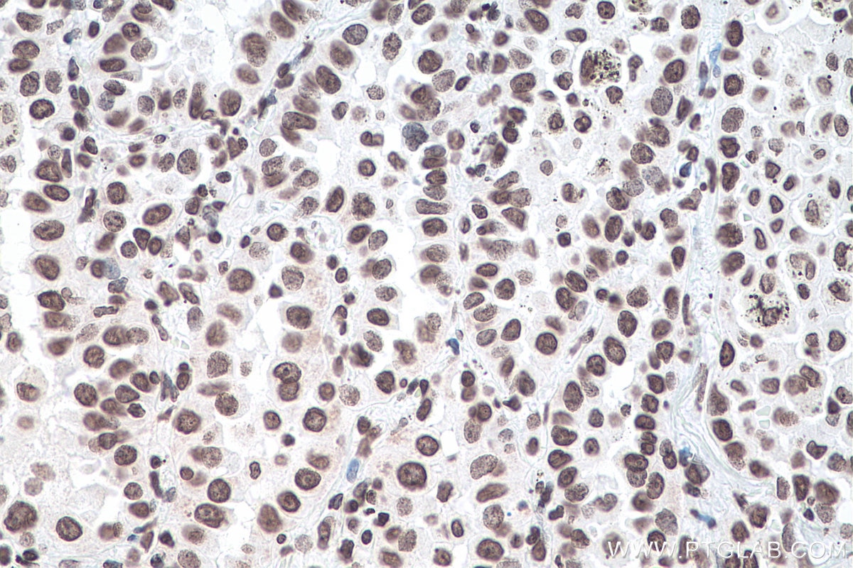 IHC staining of human lung cancer using 68055-1-Ig