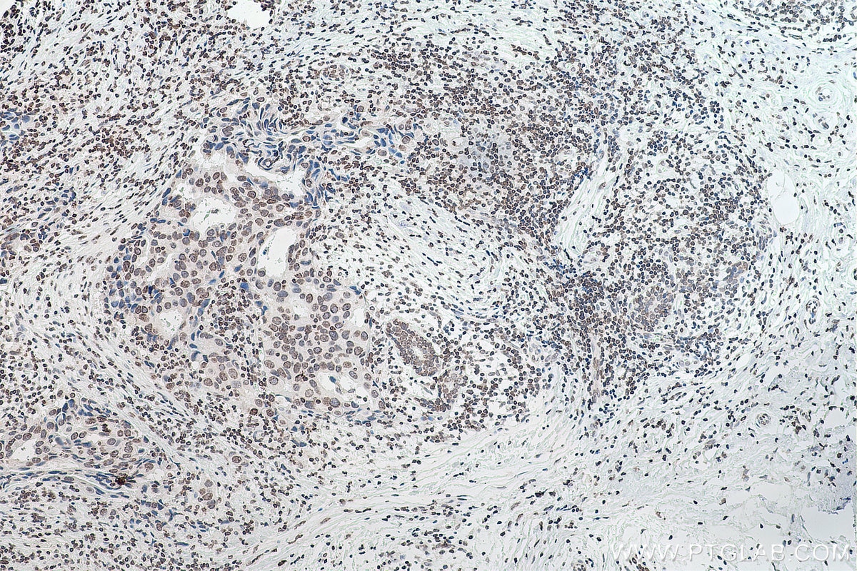 Immunohistochemistry (IHC) staining of human breast cancer tissue using chemical compound m6A Monoclonal antibody (68055-1-Ig)
