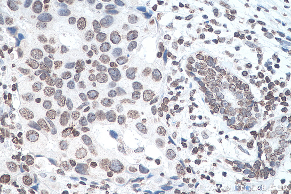 Immunohistochemistry (IHC) staining of human breast cancer tissue using m6A Monoclonal antibody (68055-1-Ig)