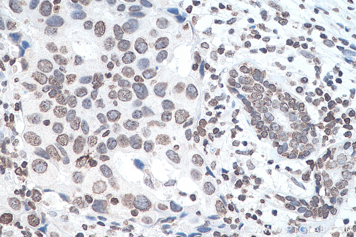 Immunohistochemistry (IHC) staining of human breast cancer tissue using chemical compound m6A Monoclonal antibody (68055-1-Ig)