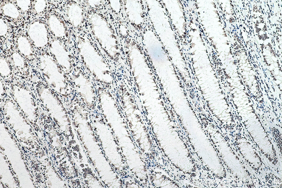 Immunohistochemistry (IHC) staining of human colon cancer tissue using chemical compound m6A Monoclonal antibody (68055-1-Ig)