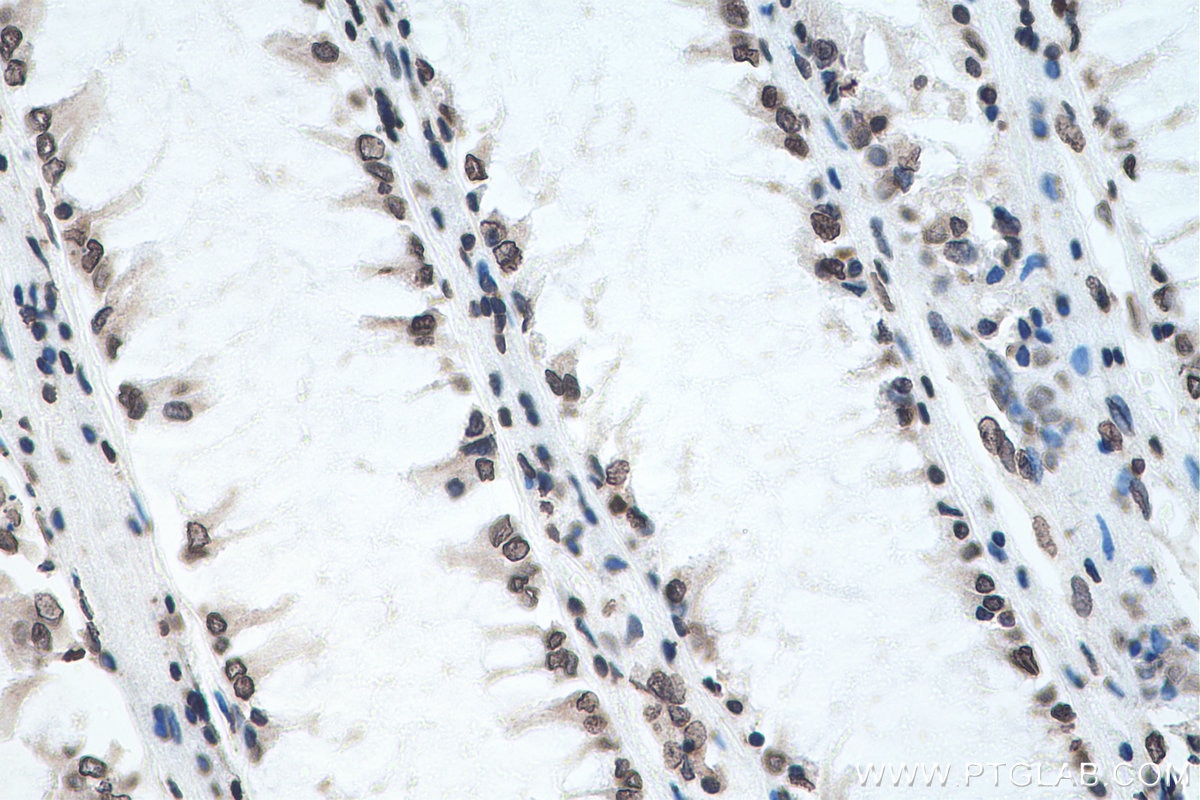 Immunohistochemistry (IHC) staining of human colon cancer tissue using chemical compound m6A Monoclonal antibody (68055-1-Ig)